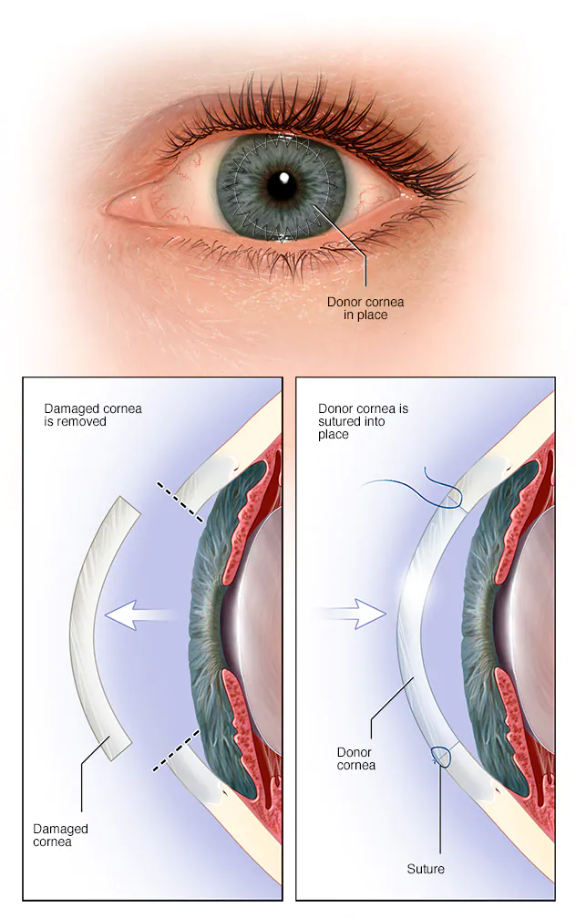 Cornea Surgery